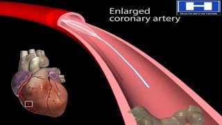 How Balloon Angioplasty is Done Animation  Coronary Angiography Procedure  Stenting in Heart Video [upl. by Ivo465]