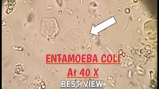 Entamoeba Coli best view in stool microscopy at 40XEColi in stool microscopyParasites in stool [upl. by Alden]