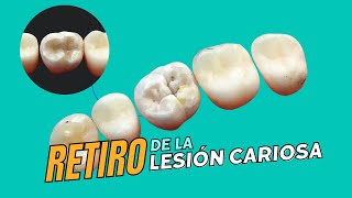 CURACIÓN de muela con resina con detalles  Oralay Dental [upl. by Stonwin]