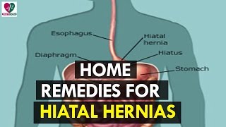 Home Remedies for Hiatal Hernias  Health Sutra [upl. by Ladew]