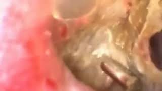 Acne treatment Big Blackhead on ear 2017blackhead in ear removal [upl. by Adnawak]