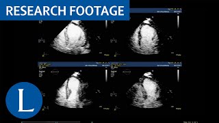 Dobutamine stress echocardiography to diagnose coronary artery disease [upl. by Notsej942]