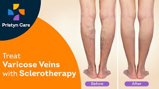 Best Treatment for Varicose Veins  Sclerotherapy [upl. by Shewchuk187]