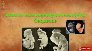 AcraniaExencephalyAnencephaly Sequence [upl. by Ulysses]