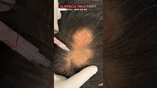 What Millenials Think About Alopecia Treatment  Viral shorts [upl. by Nnahtebazile]