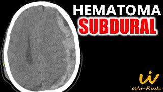 Hematoma Subdural [upl. by Nnylsor26]