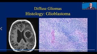 Understanding Neuropathology UCLA Brain Tumor Virtual Conference [upl. by Fasano]