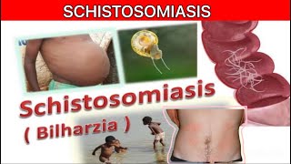 SCHISTOSOMIASIS Bilharzia  Etiology  Pathogenesis  Clinical Features  Diagnosis Treatment [upl. by Varuag]