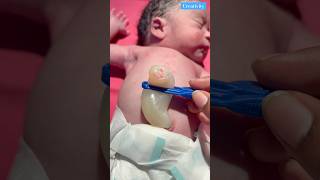 How Big Umbilical Cordmedical newbornbaby viralvideo [upl. by Whitcher]