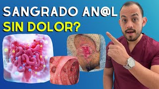 7 Causas de Sangrado Anorrectal SIN DOLOR Que No Conocias [upl. by Refotsirc]