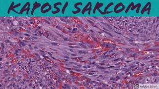 Kaposi Sarcoma 5Minute Pathology Pearls [upl. by Auhsuoj876]