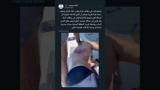 الصدر السائبflail chest دكتورسيرجن [upl. by Ikcaj]