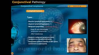 conjunctival neoplasms [upl. by Rochelle]