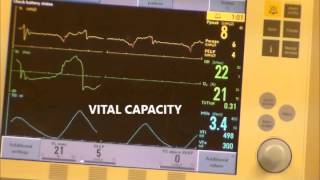 RESPIRATORY CARE Weaning Parameters w Servoi [upl. by Rehttam117]