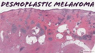 Desmoplastic Melanoma 5Minute Pathology Pearls [upl. by Paz]