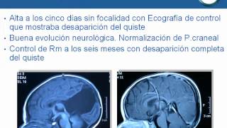 NeurorgsnetQuiste intracerebral en lactante [upl. by Anyehs]