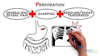 Gastroenterology  Acute NonTraumatic Abdominal Pain By Heather Murray MD [upl. by Zawde128]