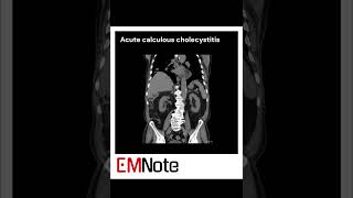 Acute Cholecystitis medical [upl. by Harwill]