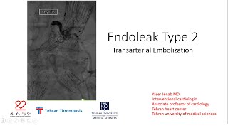 Endoleak Type 2 Transarterial Embolization [upl. by Tirzah]