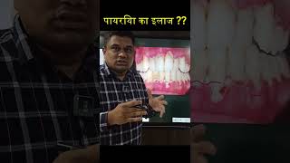 पायरिया का इलाज  gumdisease shorts [upl. by Ocisnarf]