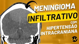 MENINGIOMA INFILTRATIVO com Sinais de HIPERTENSÃO INTRACRANIANA [upl. by Nabetse]