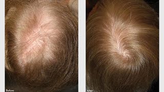 Amazing Cure For Female Pattern Baldness  Hair Loss Cure Women  Androgenic Alopecia Treatment [upl. by Spalla946]