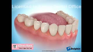 Endodontic Treatment [upl. by Hamilton]