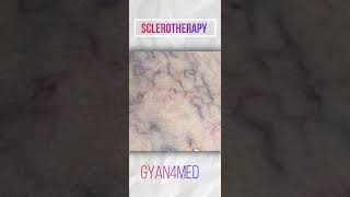 Sclerotherapy [upl. by Hsotnas]