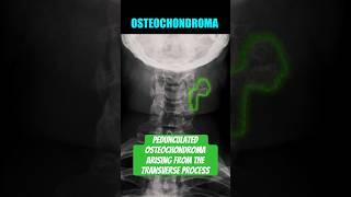 Osteochondroma of the Cervical Spine bones radiology anatomy [upl. by Amatruda]