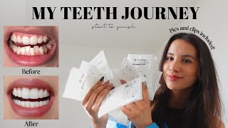 MY TEETH JOURNEY  Invisalign Composite Bonding Whitening  Answering All Your Questions [upl. by Odlanra]