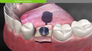 Biotech Dental Protocole chirurgical de pose dun implant dentaire KONTACT souscrestal [upl. by Ahsiea]