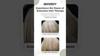 Hair restoration with exosomes shorts viral youtubeshorts mediversityhealth [upl. by Warila]