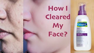 I Tested Skin Doctors Recommending Cetaphil Face Wash For 7 Days • Genuine Review • Skin Care [upl. by Aicile]