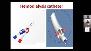 hemodialysis vascular access complications مضاعفات الوصله الوريديه الشريانيه للغسيل الكلوي [upl. by Yule]