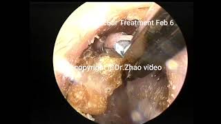 3 simple cholesteatoma clearance in the external auditory canal 10 min [upl. by Ailuy]