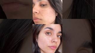 How I Reduced My Pigmentation In 2 weeks😍 [upl. by Nnylyrehc]