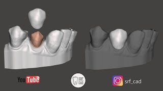 MESHMIXER DENTAL  Tutorial provvisorio in prelimatura con il modello da intraorale TEMPORARY CampB [upl. by Ahseei412]