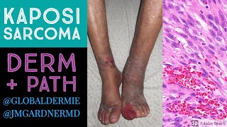 Kaposi Sarcoma DermatologyPathology Collaboration by globaldermie amp JMGardnerMD [upl. by Eiramik220]