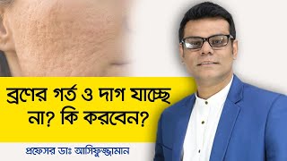 Acne scars treatment  Pimple scars treatment  Scar on face treatment  ব্রণের দাগ দূর করার উপায় [upl. by Audie261]