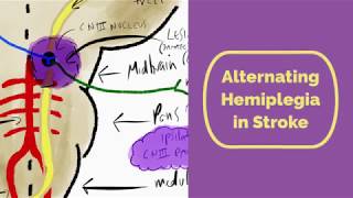 Alternating Hemiplegia in Stroke [upl. by Poliard503]