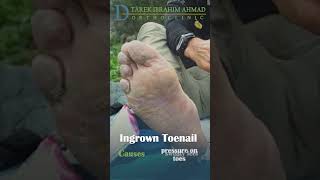 what is an impacted nail   ingrown toenail [upl. by River]