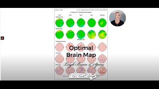 How to Interpret Your qEEG Brain Map [upl. by Einnim]