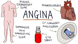 Understanding Angina Visual Explanation for Students [upl. by Oile549]