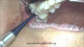 Buccally placed supernumerary molar tooth removal using elevator [upl. by Airdnax]