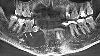 Enucleation of dentigerous cyst  dentistry  surgery  cyst  supernumerary teeth  amazing [upl. by Adnahsor354]