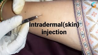 intradermal or skin injection [upl. by Lien]