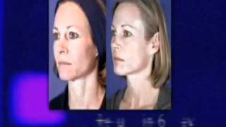 REJUVENATION FACIALE Laser CO2 Micro Fractionné MiXto Essonne [upl. by Meehan672]