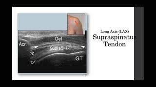 MSK Ultrasound Evaluation Differentiation of Tendinopathy vs Tear in the Rotator Cuff [upl. by Eetnwahs]