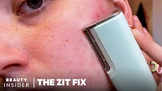 200 Dermaplaning Device Claims To Remove Flaky Skin And Peach Fuzz  The Zit Fix [upl. by Ilyse]