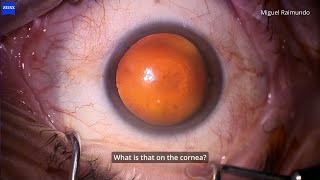 What is that on the cornea PostPRK tilt and chop cataract case [upl. by Mrots]